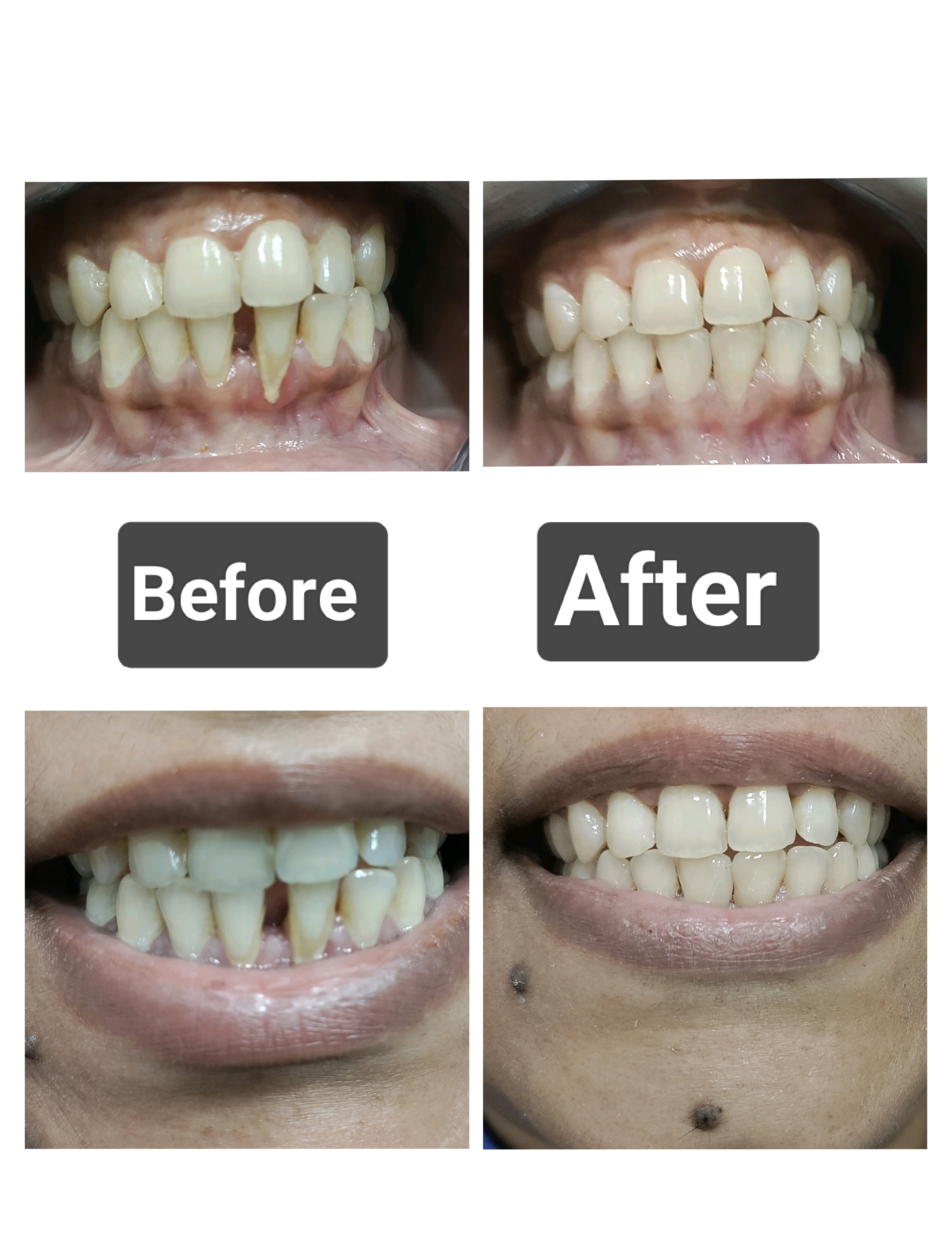 Gap Closure