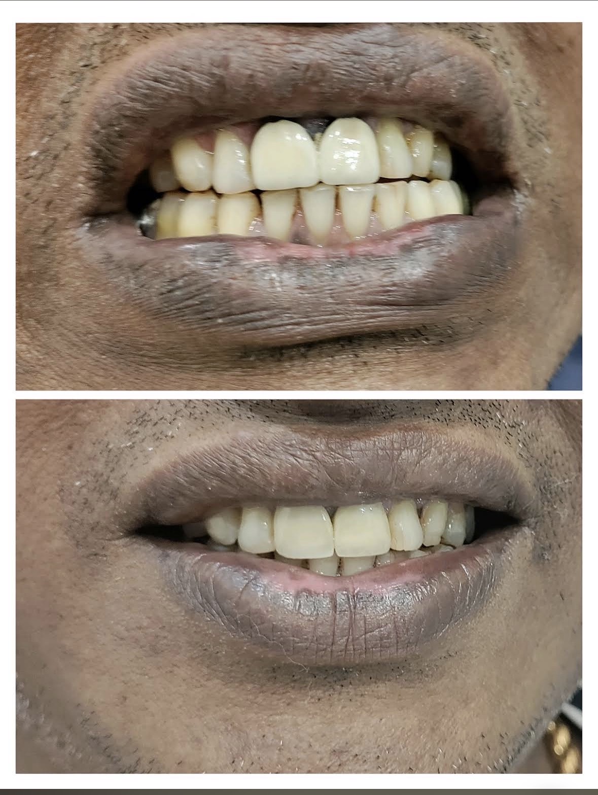 Crown Restoration