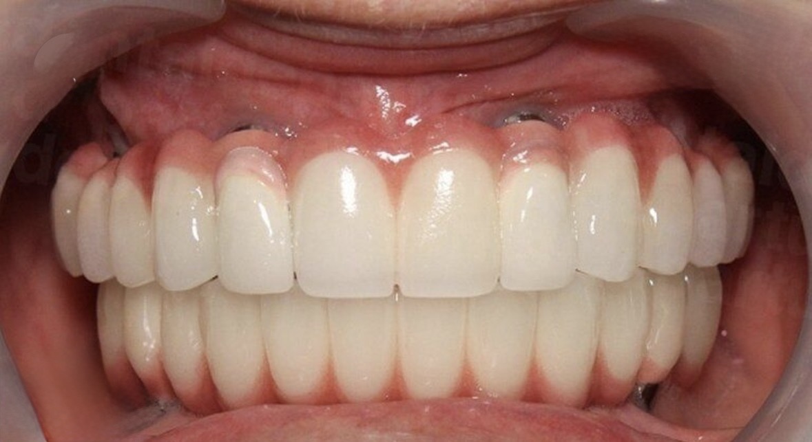 Full Mouth