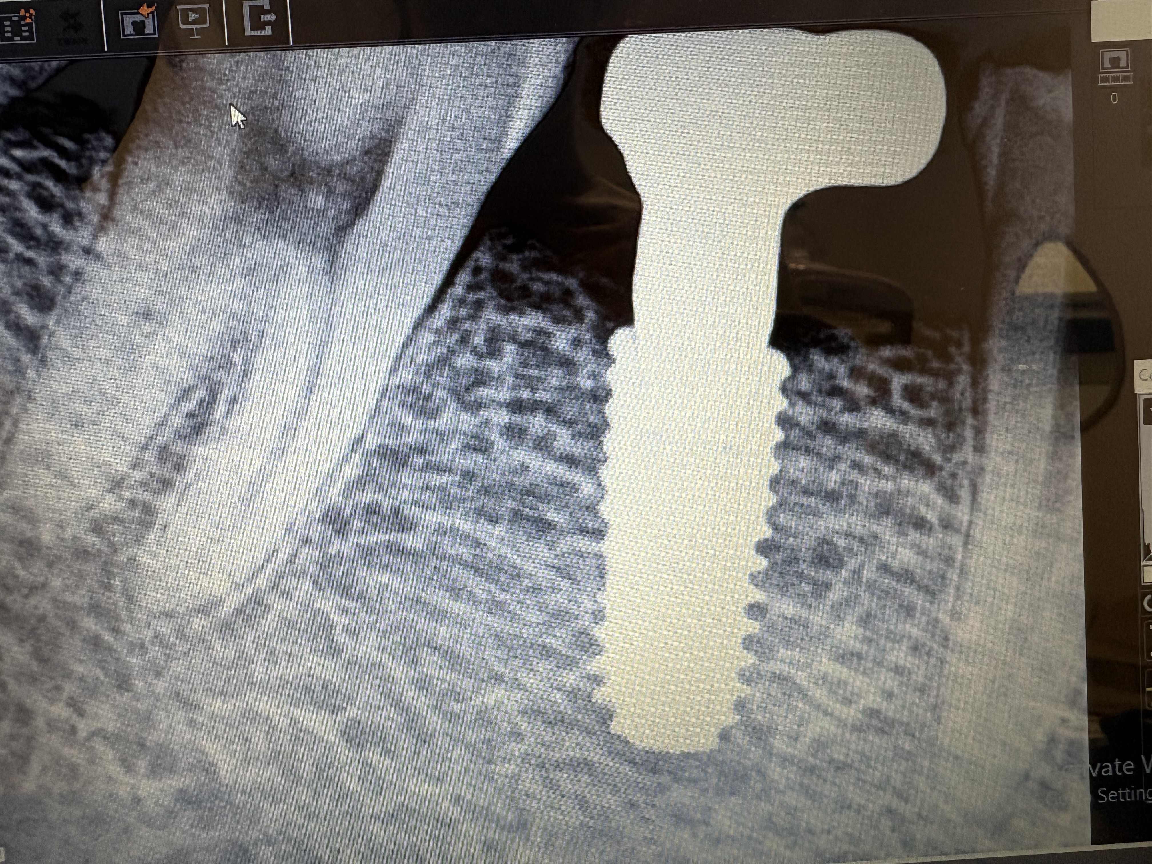 Implant