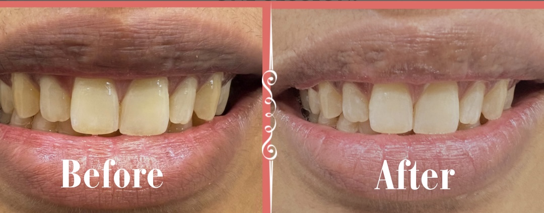 Whitening